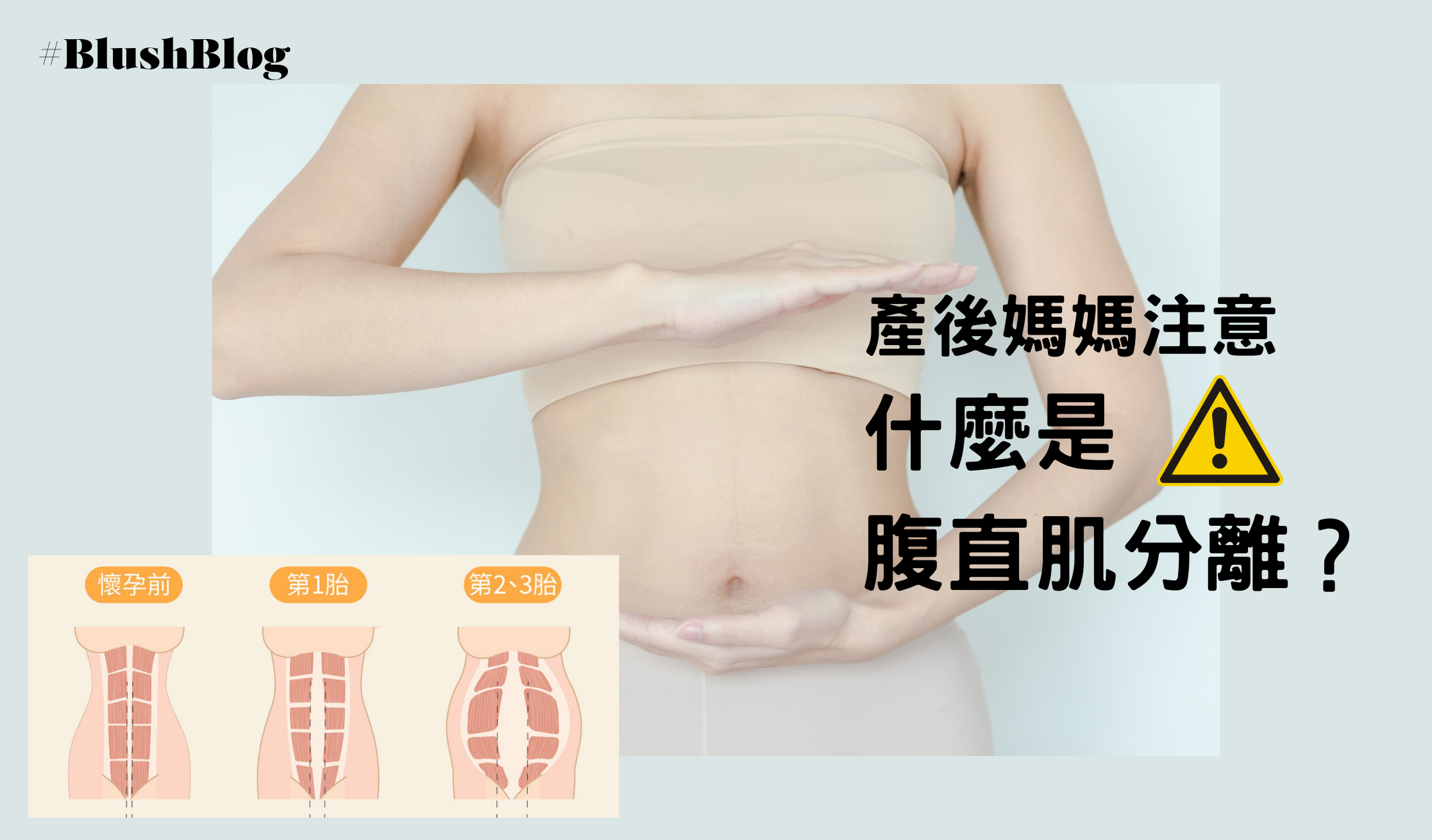 懶理產後腹直肌分離的嚴重性！